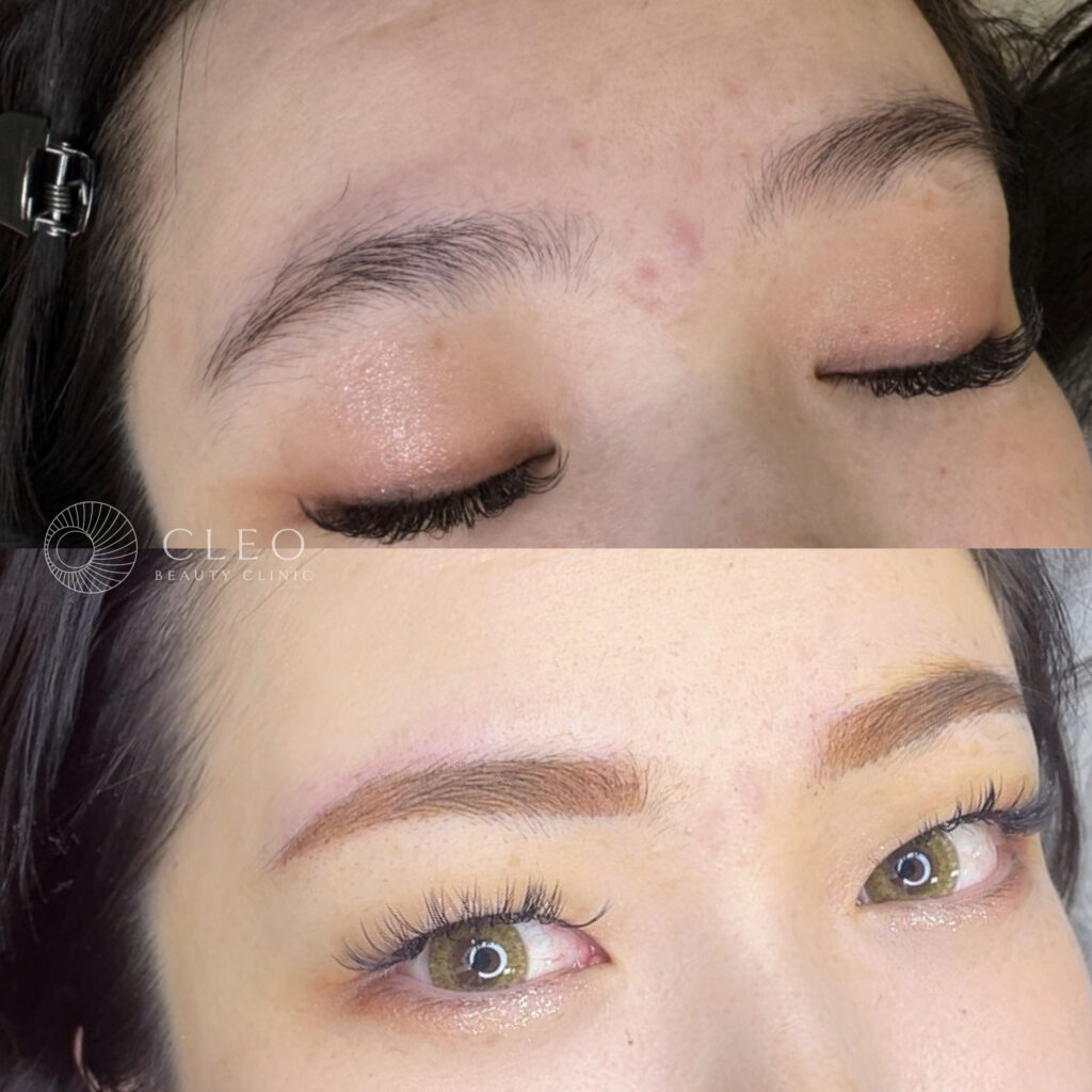 20代女性、韓国でのアートメイクのリタッチ症例