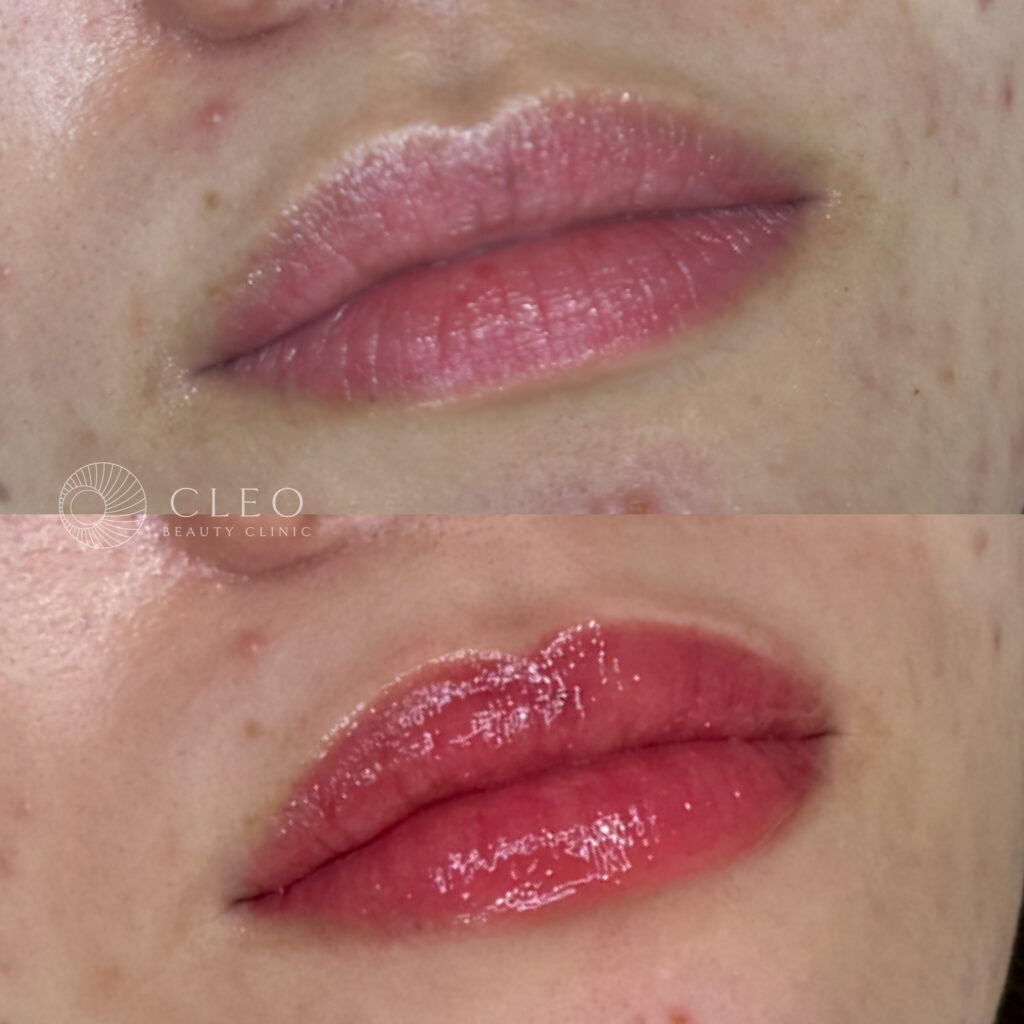 30代女性、リップの他院リタッチ症例、血色感アップ、アートメイク症例