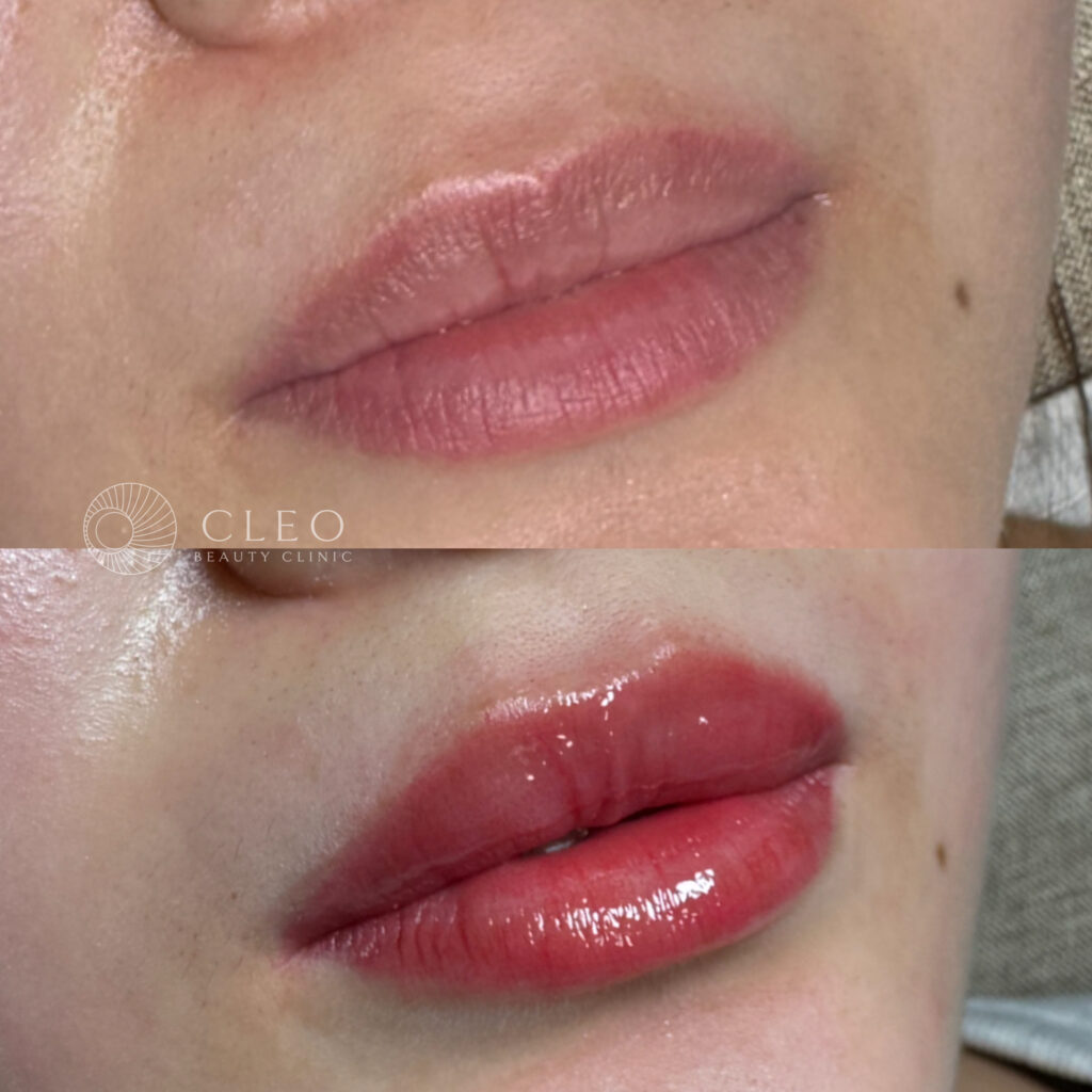 30代女性、血色感アップ アートメイク症例