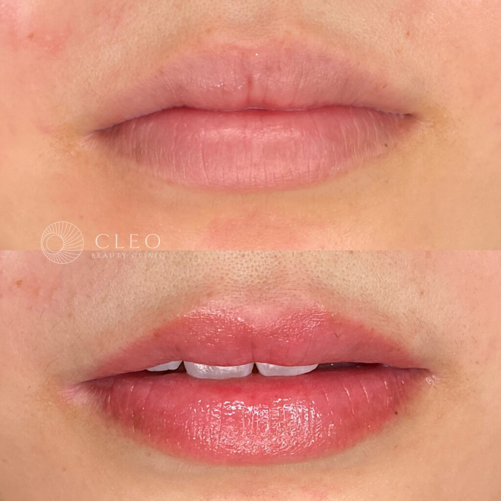 20代女性 血色感アップ カラーチェンジ症例