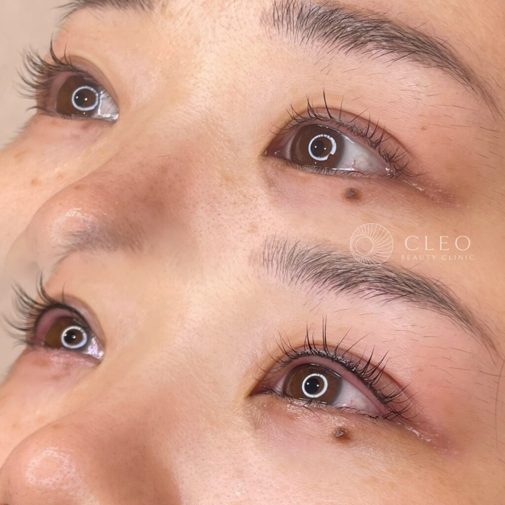 20代女性 アイラインアートメイク症例