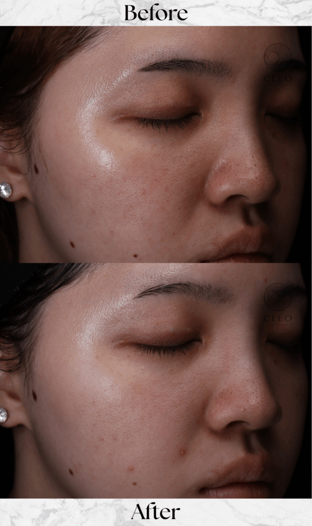 IPL光治療 3回 20代女性の症例 - 赤み改善・トーンアップ　症例縦比較