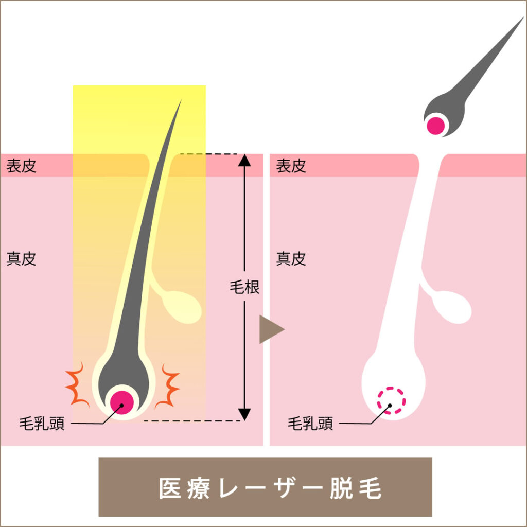 医療レーザー脱毛の仕組みの図解