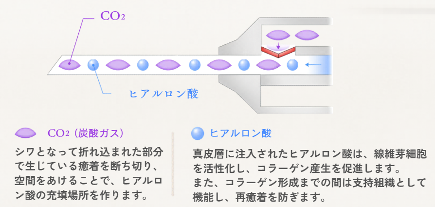 ジュブゼン　仕組み