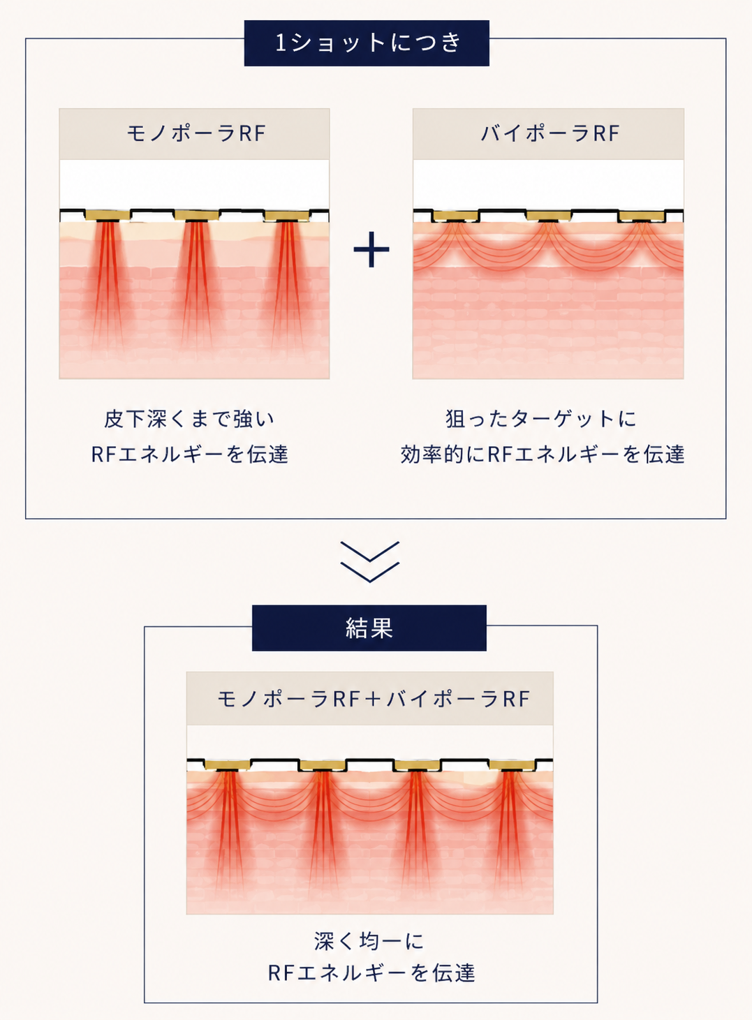 ポテンツァPrimeの仕組み モノポーラとバイポーラの同時照射による肌全体への伝達